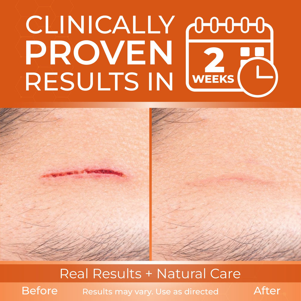 ABERA Scar Cream packaging box shows advanced formula.