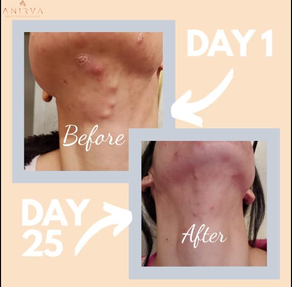 Anirva ClearDerm label with ingredients and vegan-friendly formula