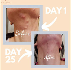 Anirva ClearDerm label with ingredients and vegan-friendly formula