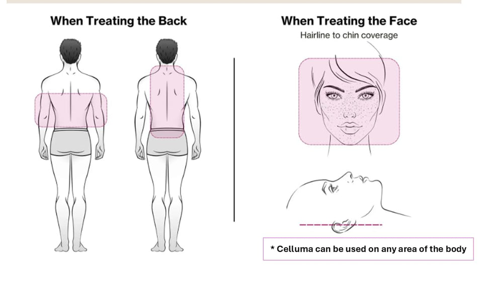 Celluma PRO LED panel wrapped around an arm for hands-free therapy.
