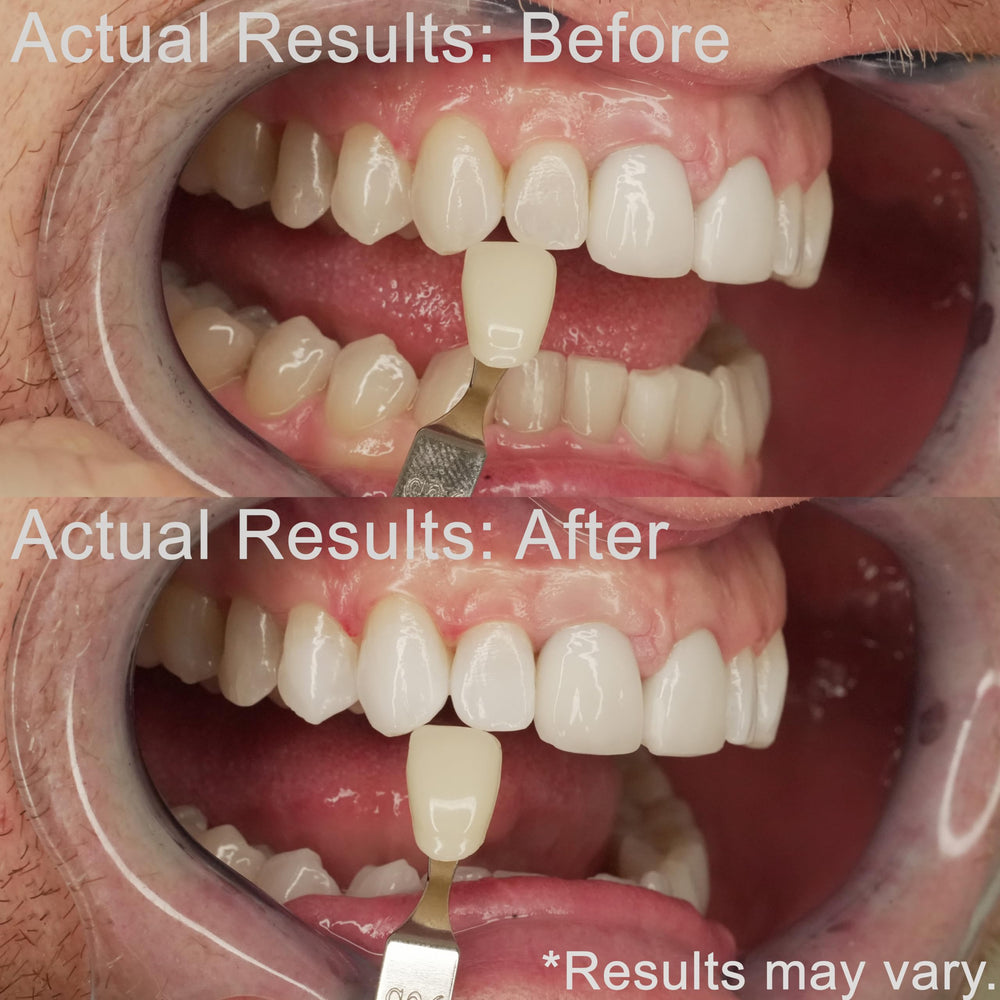 EZZI whitening results image showing brighter teeth after overnight use.