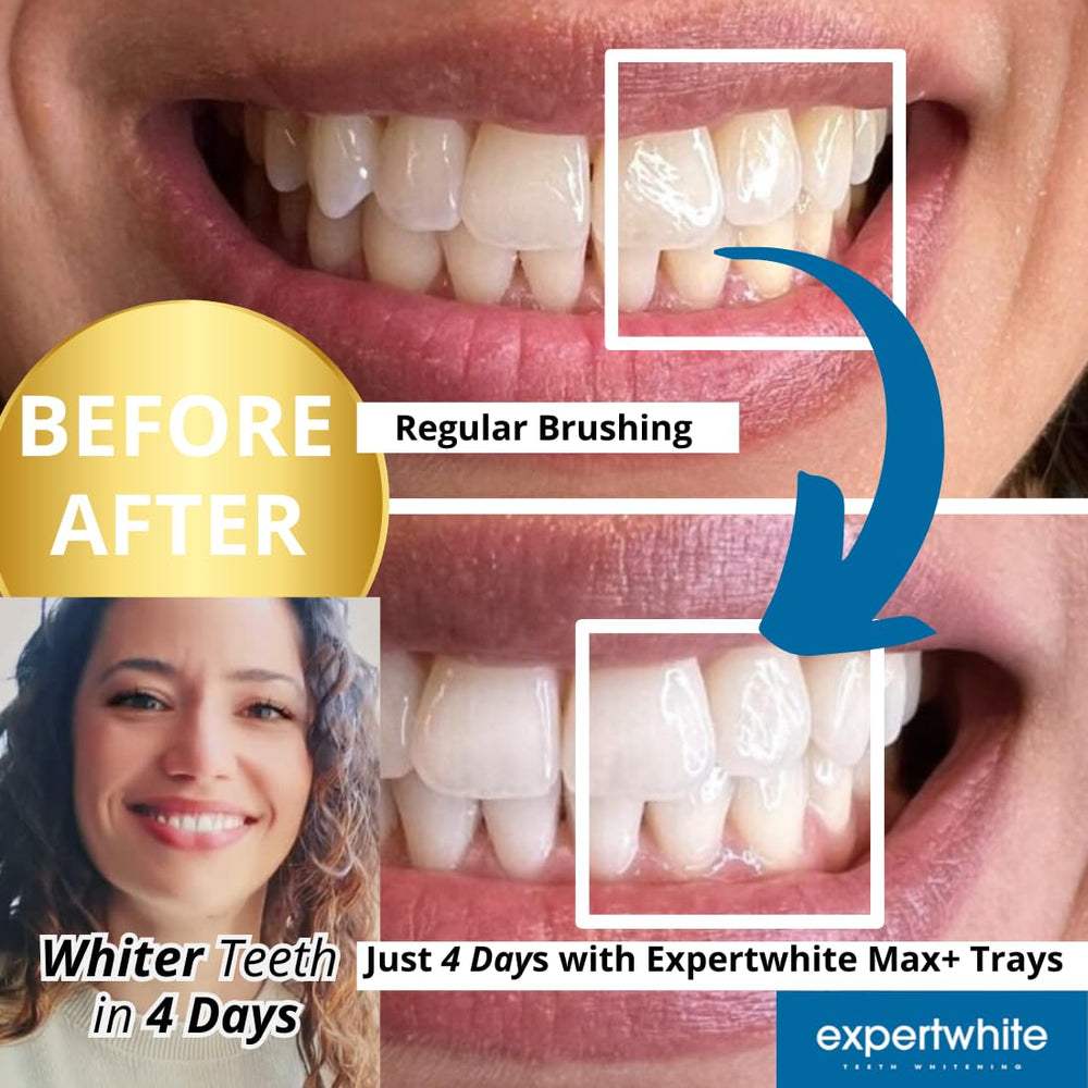 ExpertWhite Max Glow Trays dry-gel formula for mess-free use.