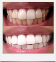 Deep stain removal from coffee, wine, and tea with Expertwhite gel.