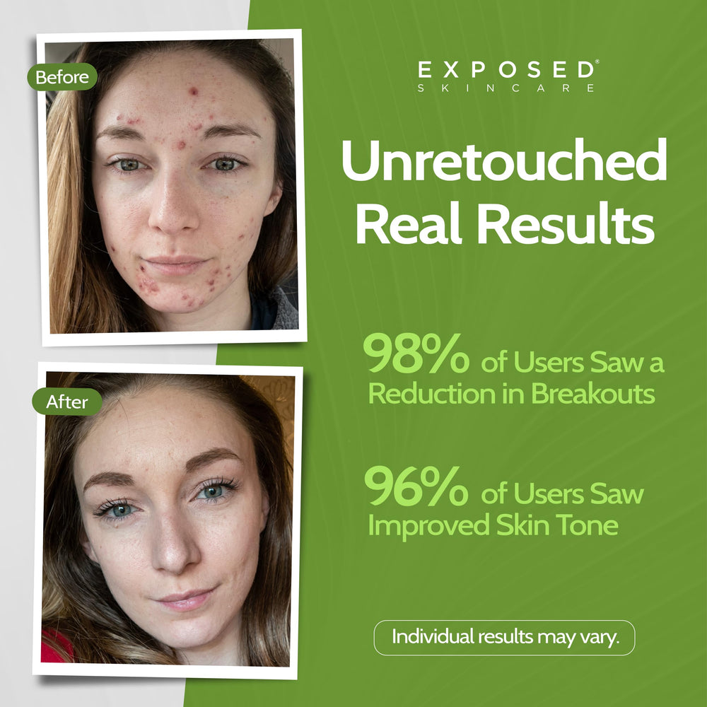 exposed skin care probiotic label closeup showcases vegan non-gmo formulation and skin benefits