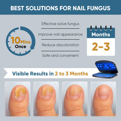 FEIGOMA Nail Fungus Light Device is applied to toenails for healthy appearance.