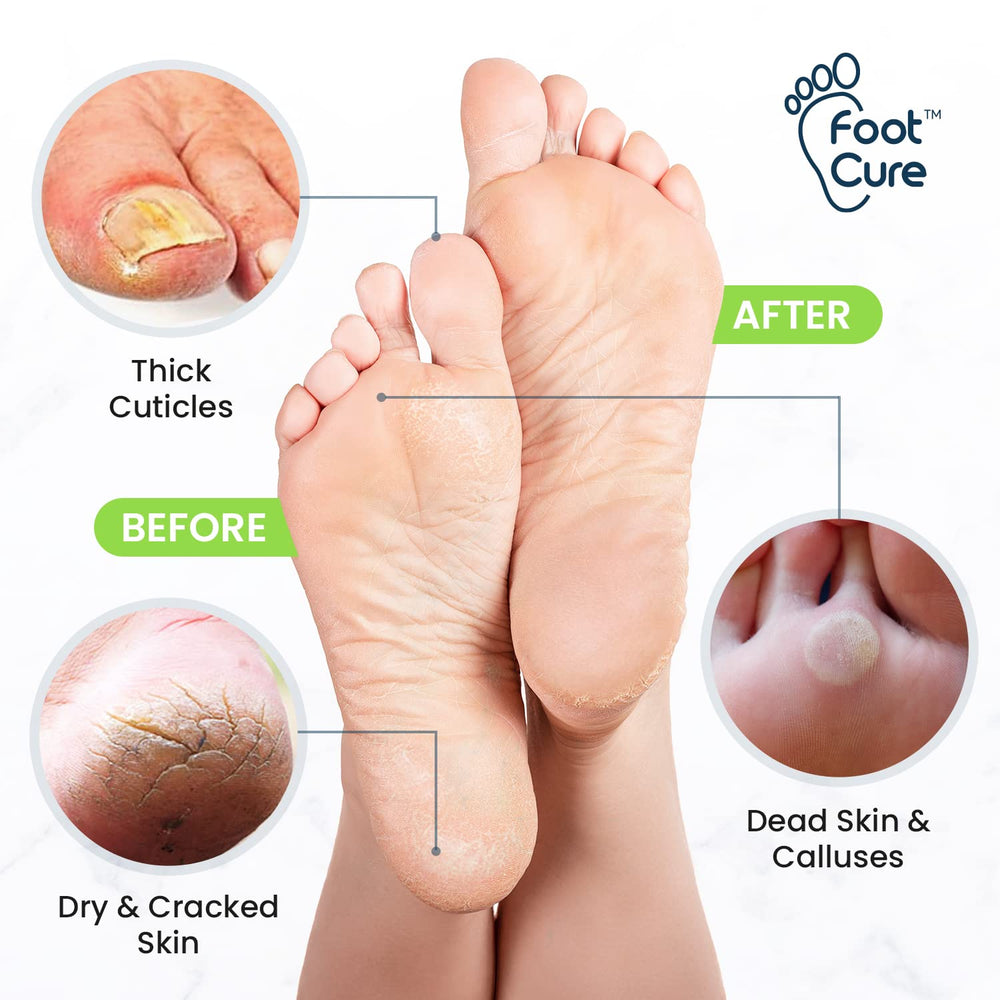 FOOT CURE toenail softener kit enables easy at-home maintenance