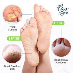 FOOT CURE toenail softener kit enables easy at-home maintenance