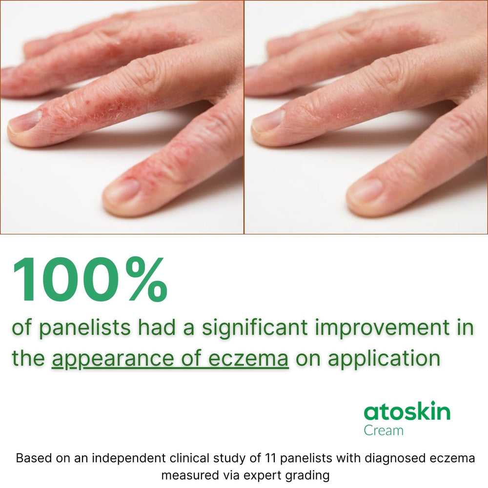 HVSun Atoskin eczema cream applied to forearm for daily care.