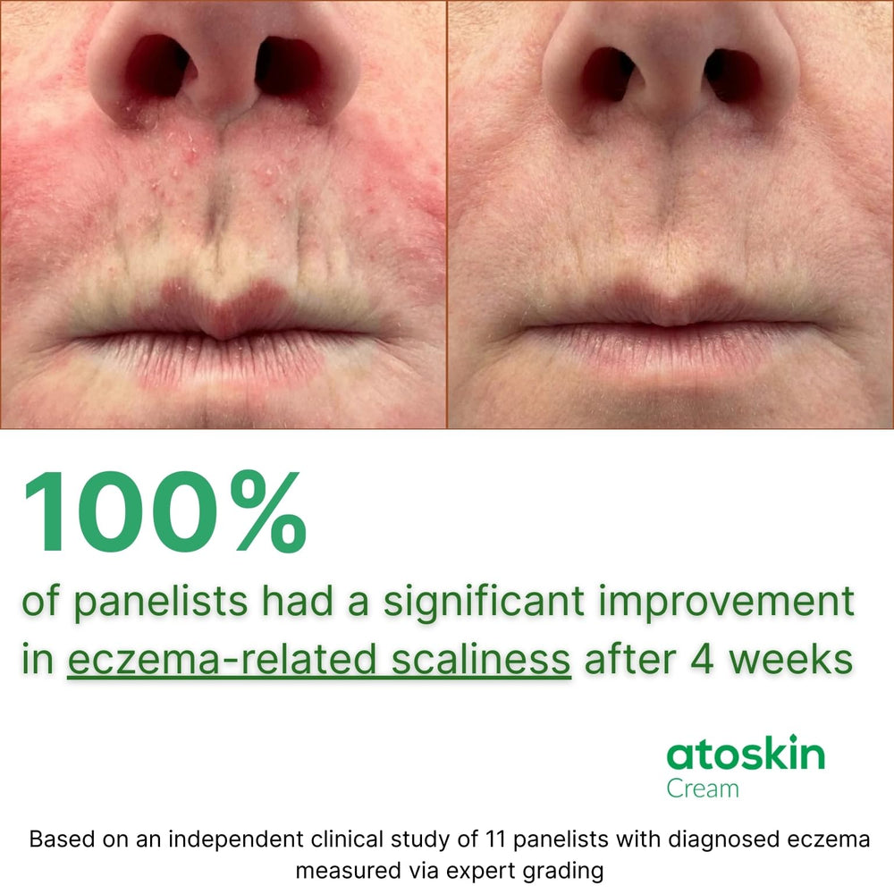 Family using HVSun Atoskin Eczema Cream on sensitive skin