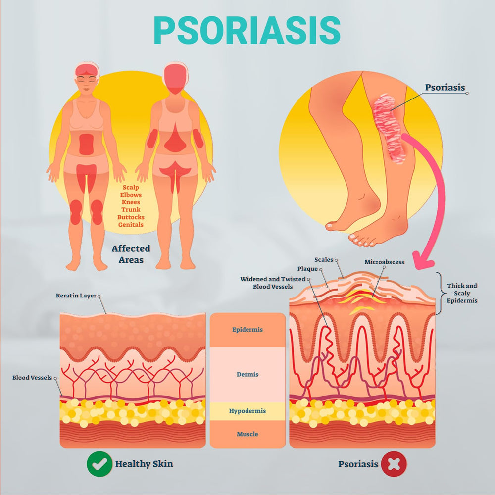 Ishancare Psoriasis Cream ingredients close-up highlighting colloidal oatmeal and botanicals
