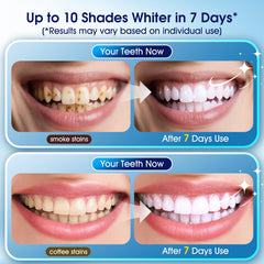 KOAEO LED light activates whitening gel for faster, even results.