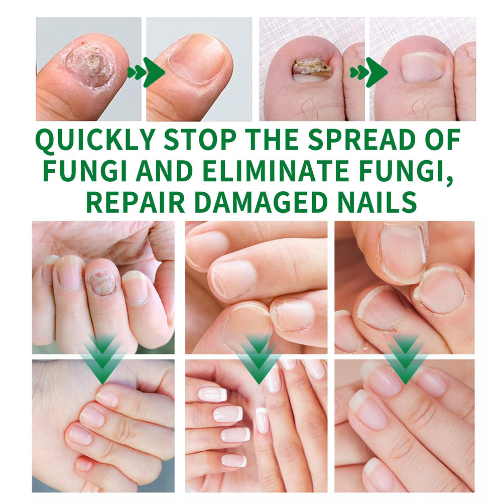 KUNLEN Multi-Purpose Nail Oil Serum bottle closeup demonstrating nourishment for nails.