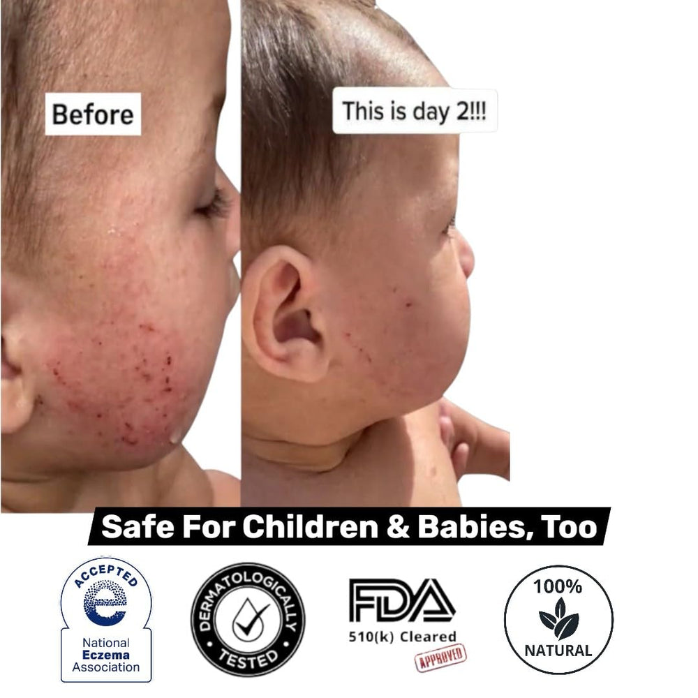 Loma Lux Eczemol NEA Seal label signals eczema safety recognition.