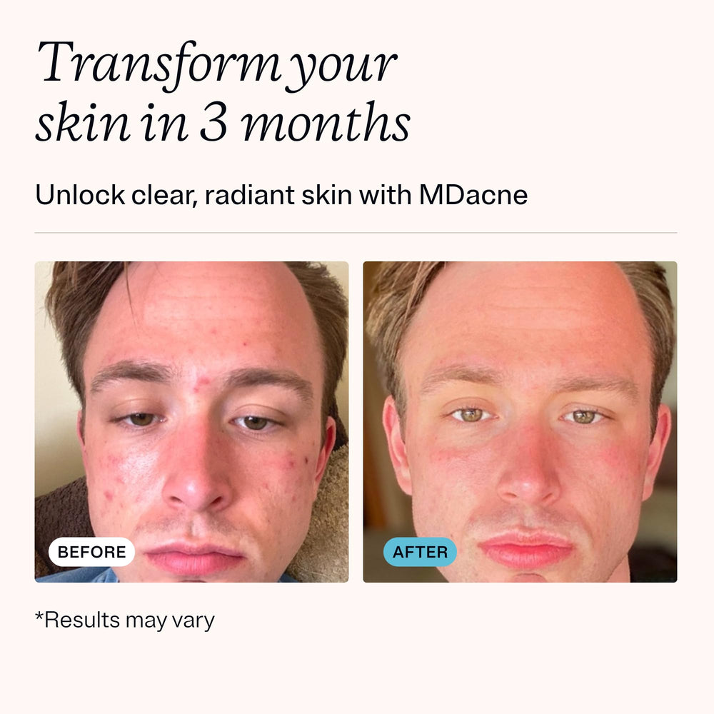 MDacne packaging on display with 30 day supply details