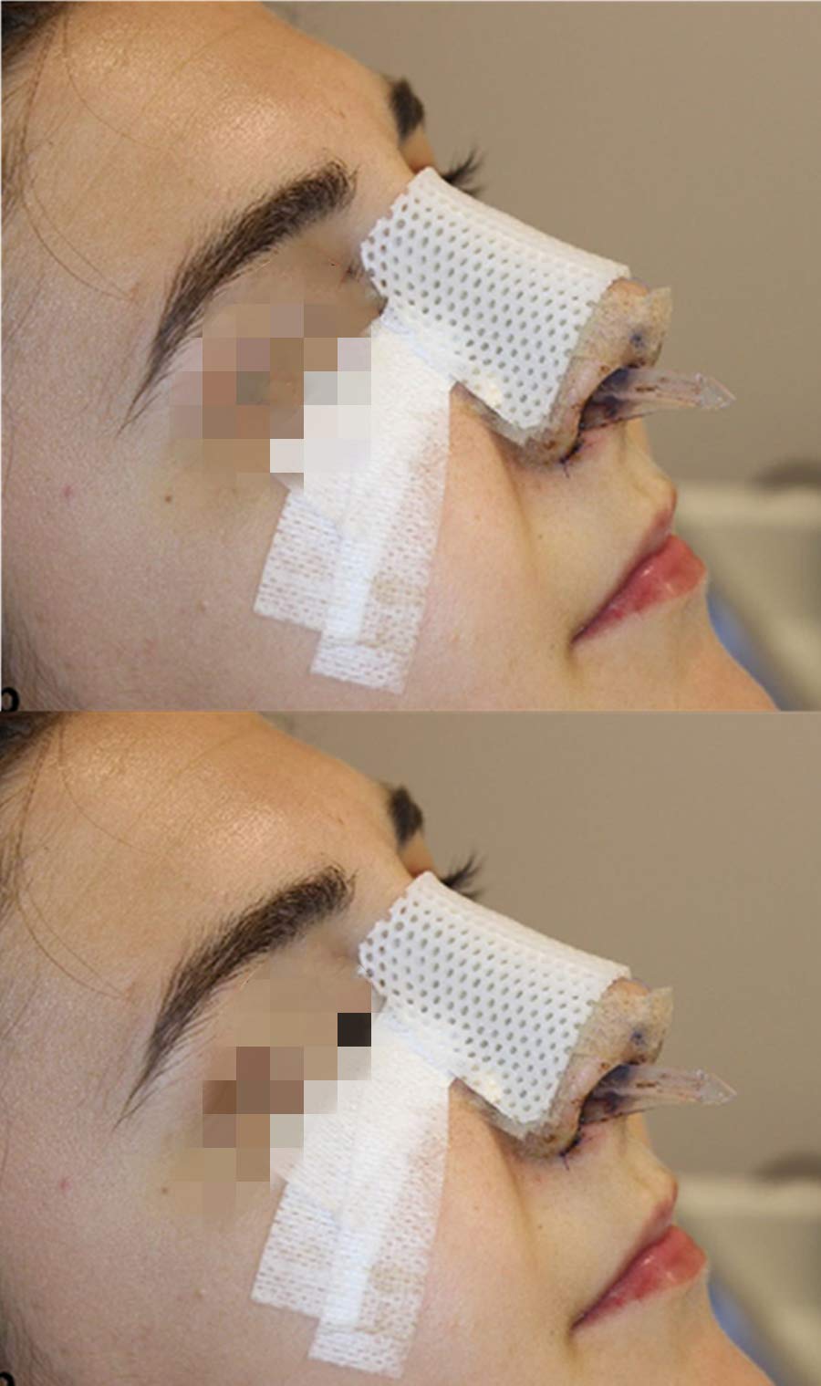 Mediss nasal splints activated by warm water for soft, moldable fit.