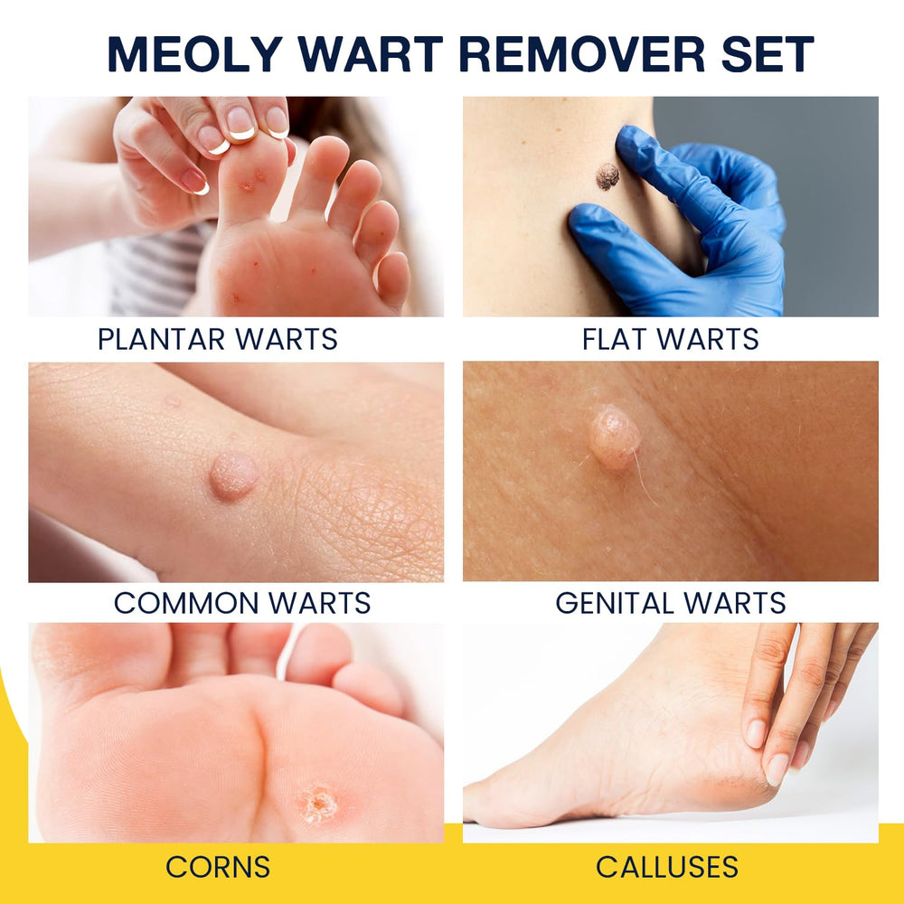 MEOLY salicylic acid wart remover bottle for targeted at-home care