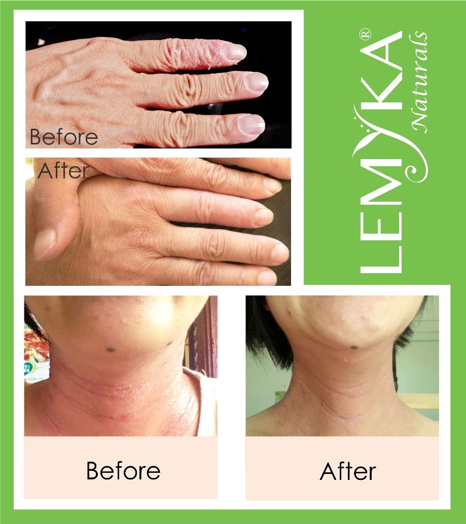 Michaderm LEMYKA image shows daily-use application on face and hands.