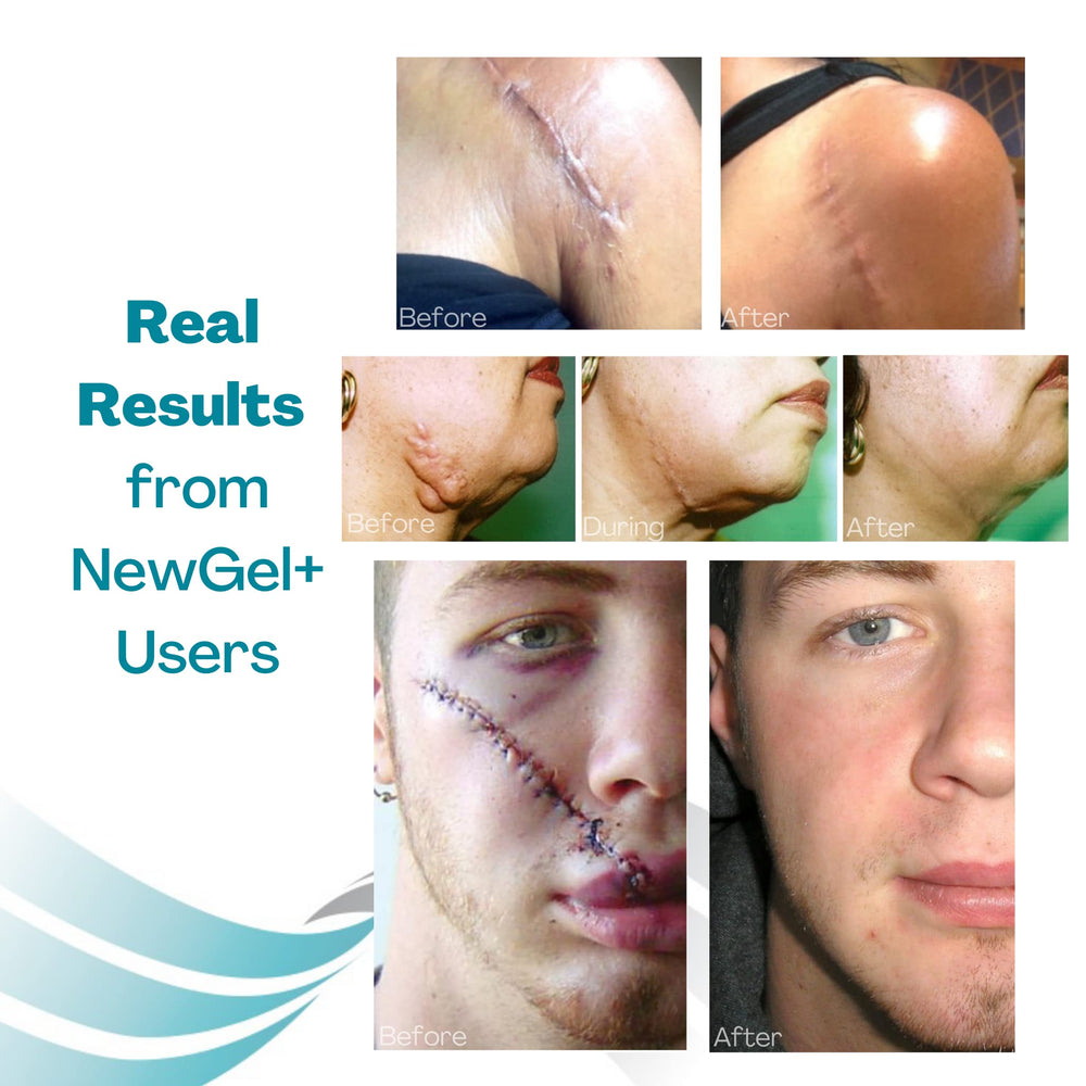 MyNewGel breast reconstruction scar kit in use on healing areas around the breast.