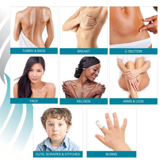 MyNewGel NewGel+ ideal for irregular scar areas post-surgery.