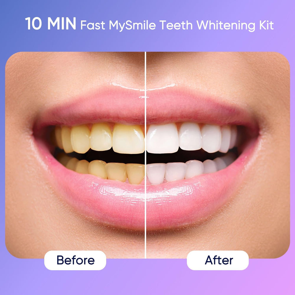 MySmile Deluxe LED light activated for faster whitening sessions.