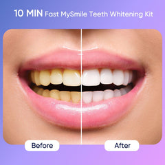 MySmile Deluxe LED light activated for faster whitening sessions.
