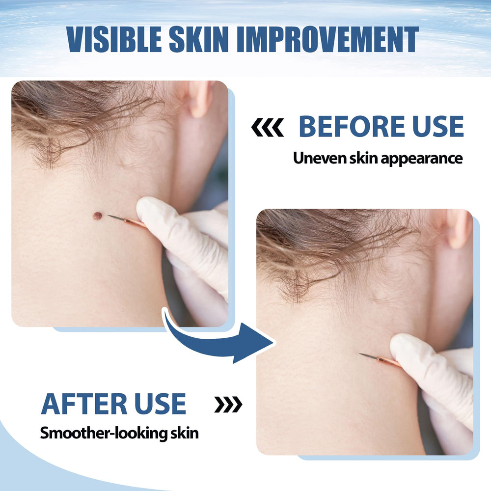 NateNatenight molluscum cream packaging shows 30g size, travel-friendly.