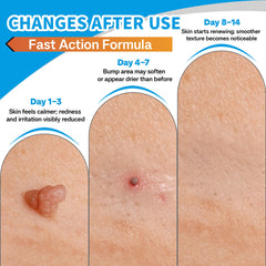 Applying NateNatenight Molluscum Support Cream to affected skin area.
