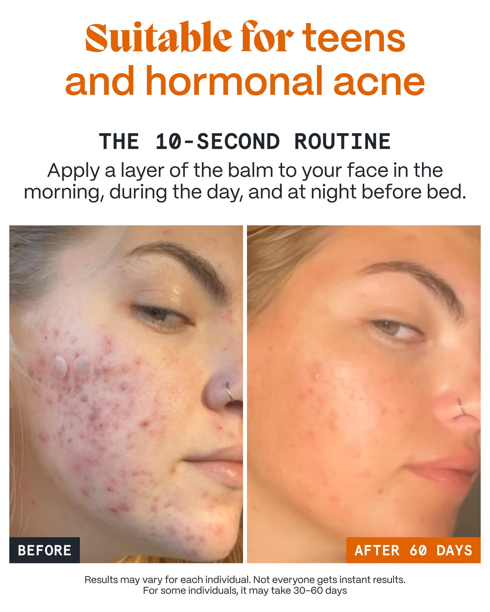 Norse Organics Pimple Scars Balm 2.0 application scene showing daily massage ritual