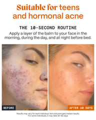 Norse Organics Pimple Scars Balm 2.0 application scene showing daily massage ritual