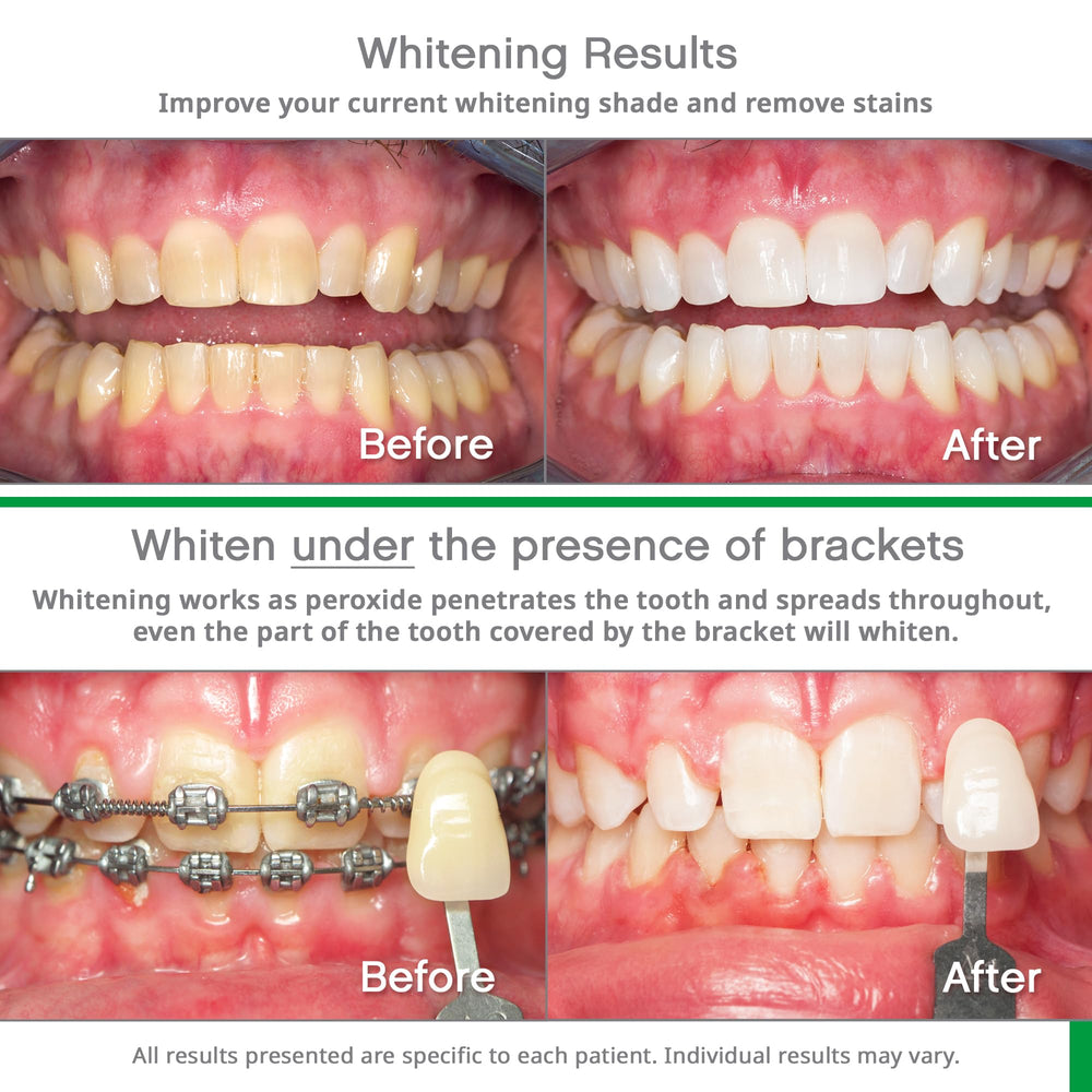 Opalescence toothpaste mint flavor for whitening maintenance.