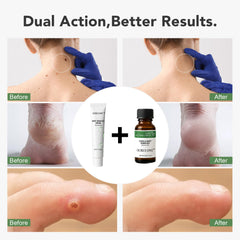 ourui one skin-tag ointment 2-step targets larger tags with gentle application