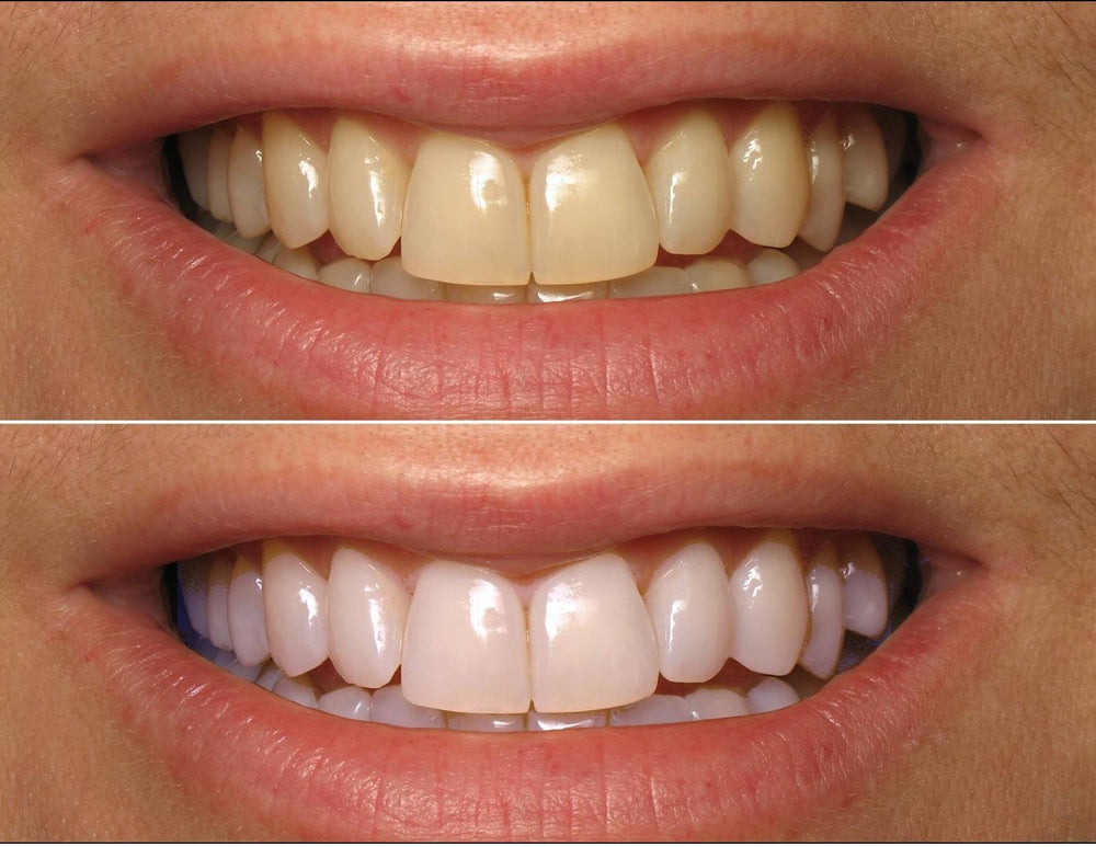ProDental 35-percent carbamide peroxide syringe ready to tackle surface stains