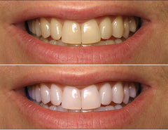 ProDental 35-percent carbamide peroxide syringe ready to tackle surface stains