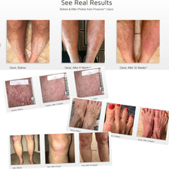 Prosoria treatment system natural ingredients label highlight botanicals.