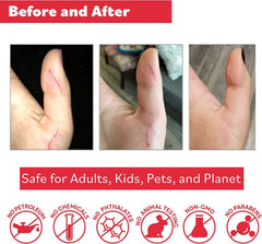 Close-up of Puremedy aiding skin care for burns and wounds.