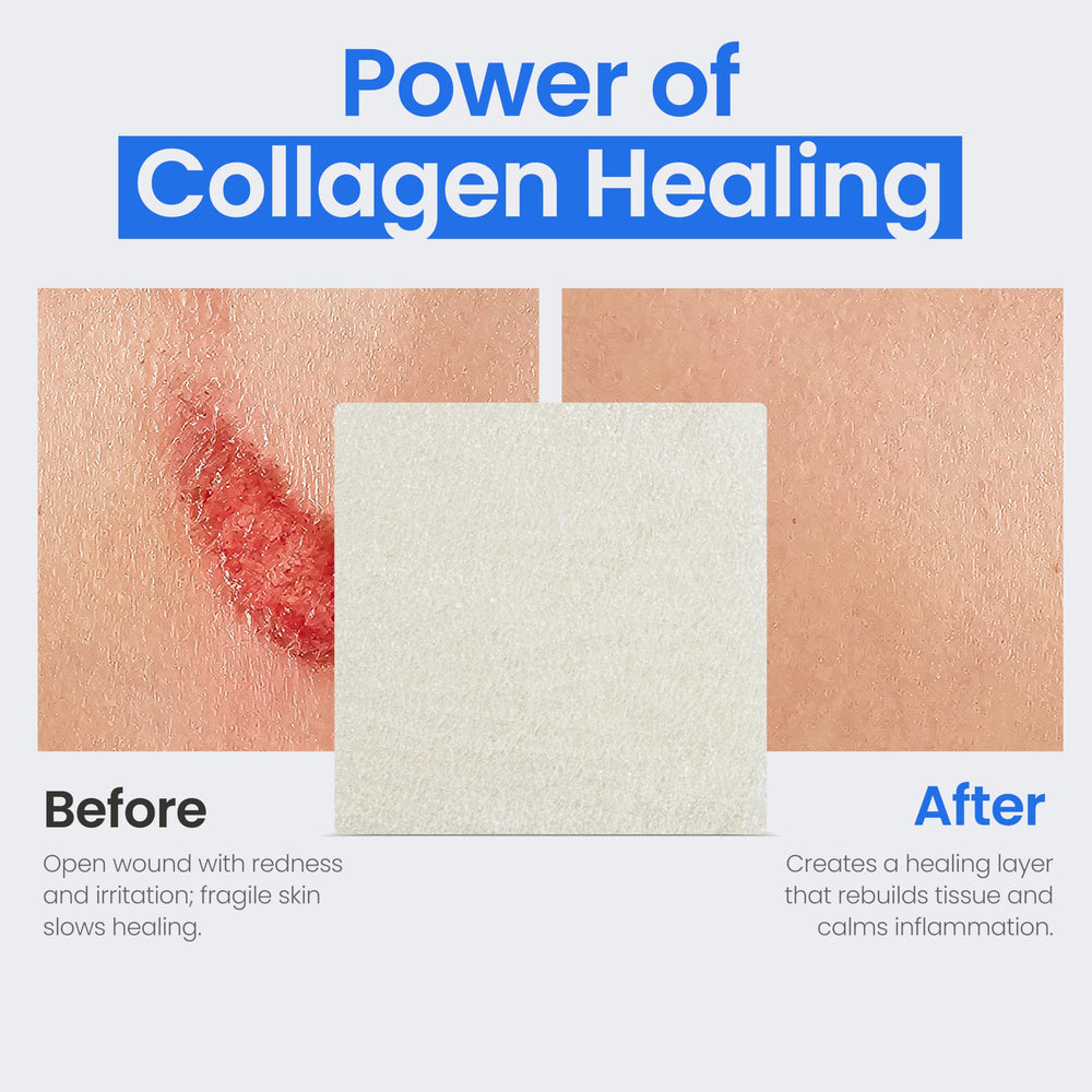 Simpurity collagen pads glutaraldehyde-free dressing offers careful wound support.