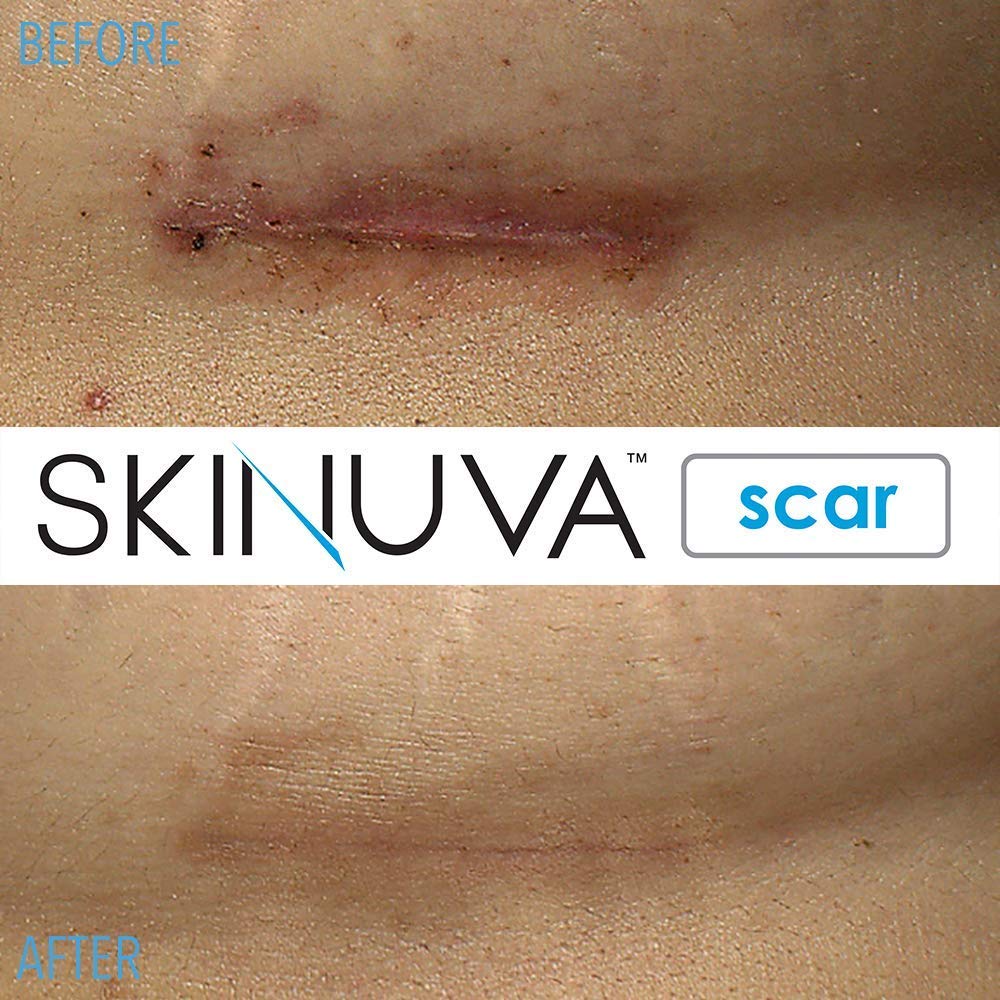 Skinuva packaging box front showcases premium scar treatment product