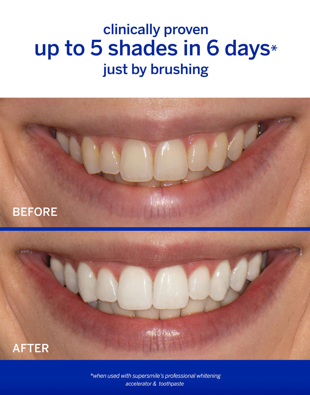 Supersmile Accelerator gel-application shows targeted whitening action