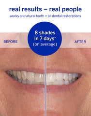 Supersmile Superstrips being used for a quick 15-minute treatment.