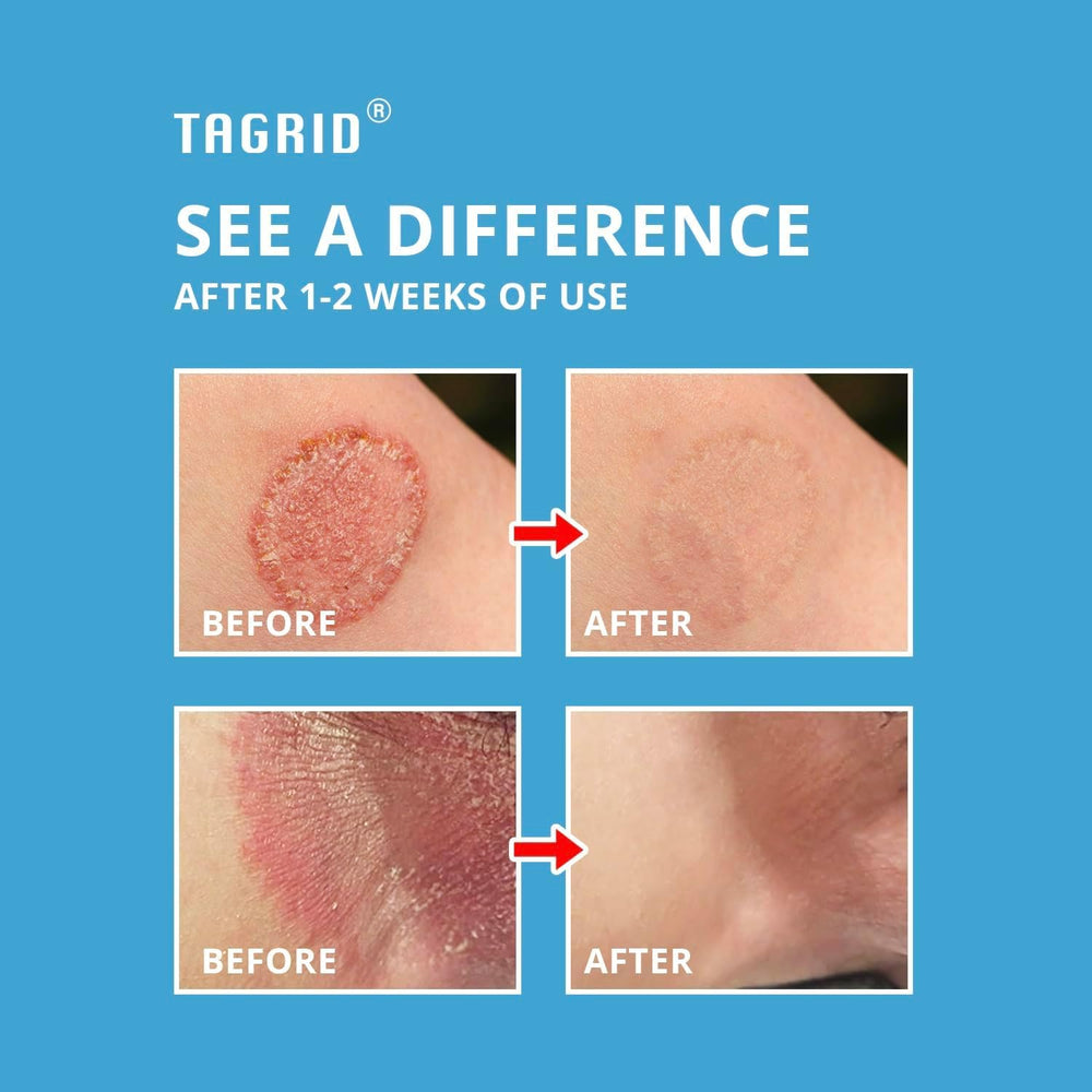 Cooling effect of TAGRID cream on itchy skin.