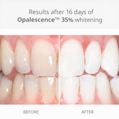 Ultradent Opalescence 35% gel close-up showing precise syringe delivery