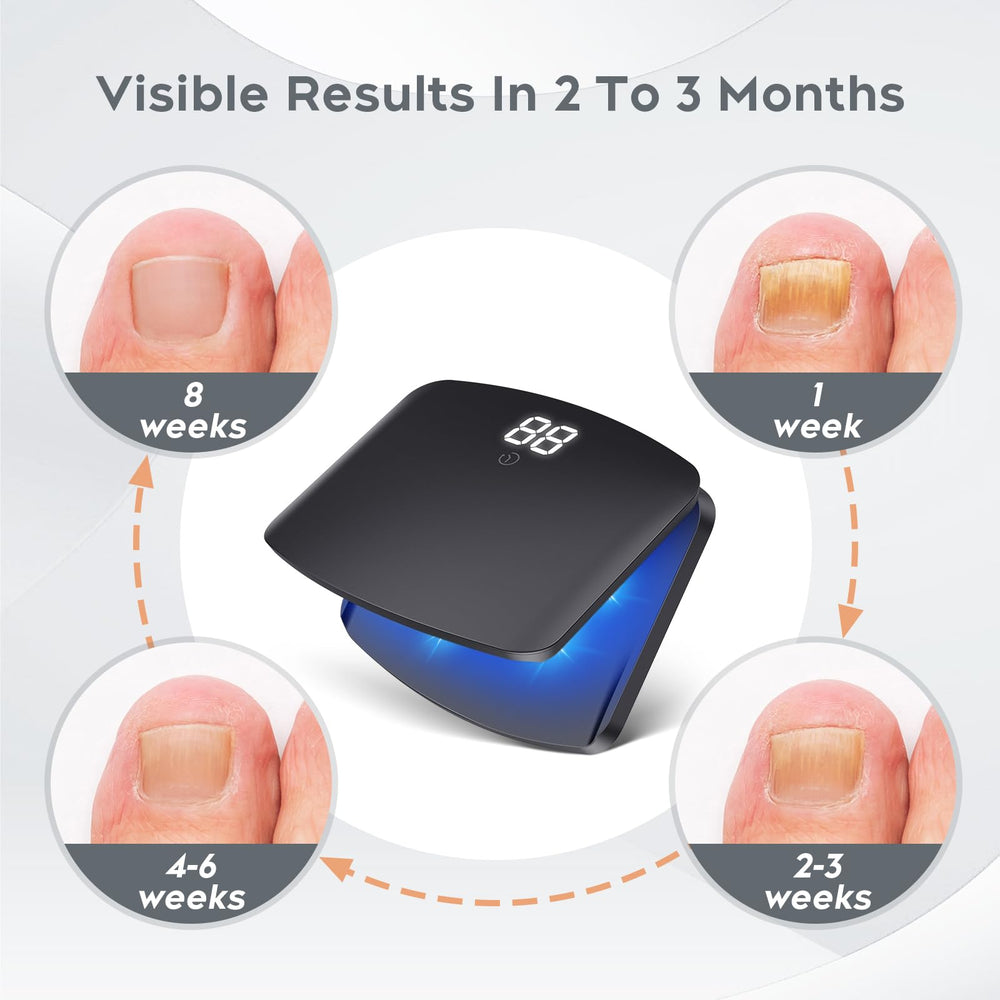 ZZP Nail Fungus Light Device treated nails close-up showing potential improvement with routine use.