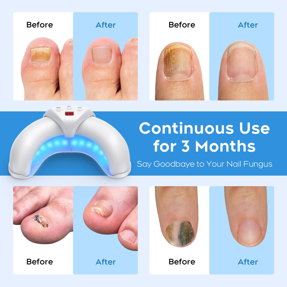 ZZP New Nail Fungus Device nails before and after treatment reference.