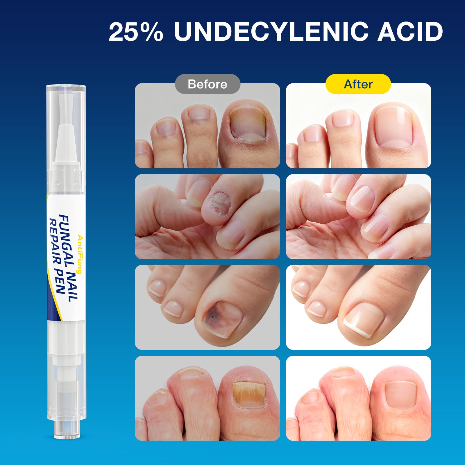 AntiFung 3-pack box image shows travel-friendly kit for consistent nail care.