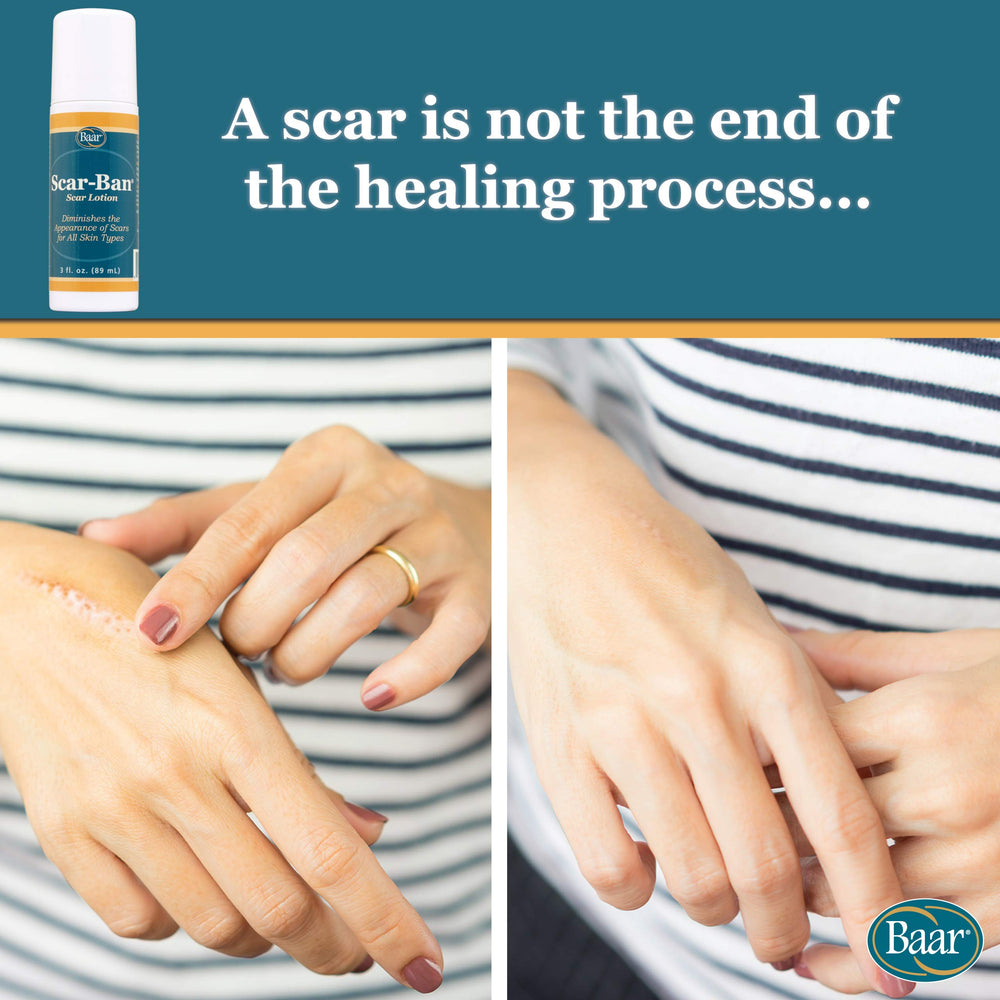 Baar Scar Ban Roll On roller-ball in use for easy, precise application.