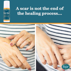 Baar Scar Ban Roll On roller-ball in use for easy, precise application.