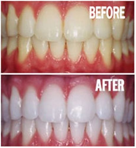 Bright White Smiles 15-minute whitening session for quick shade improvement
