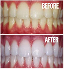 Bright White Smiles 15-minute whitening session for quick shade improvement