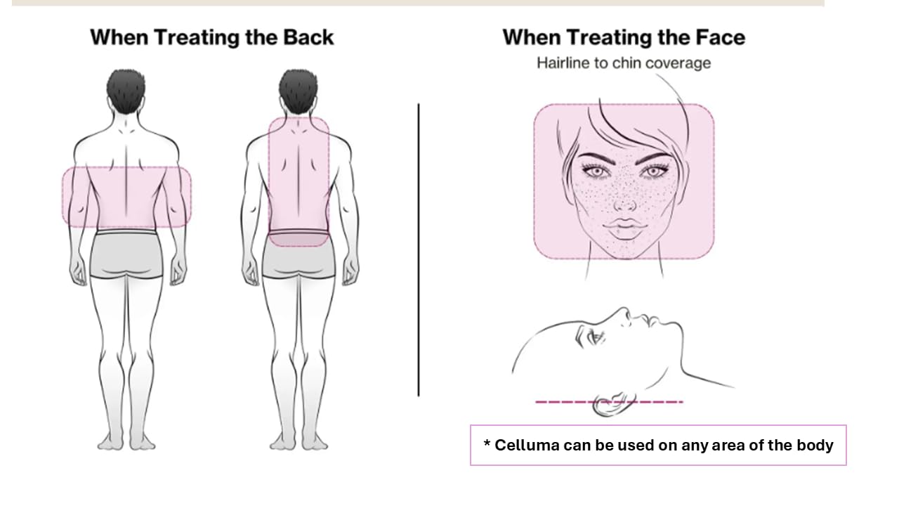 Celluma PRO LED panel wrapped around an arm for hands-free therapy.