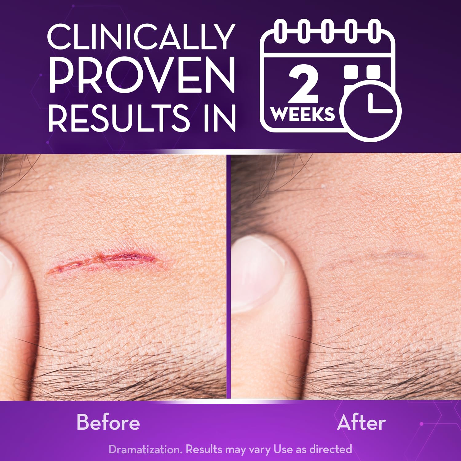 Cicatricure scar gel smooths and hydrates scar tissue